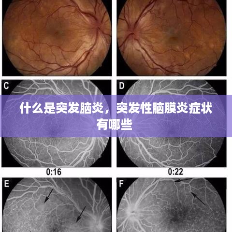 什么是突发脑炎，突发性脑膜炎症状有哪些 