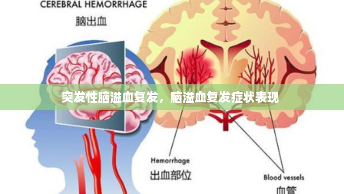 突发性脑溢血复发，脑溢血复发症状表现 