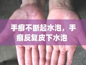 手癣不断起水泡，手癣反复皮下水泡 